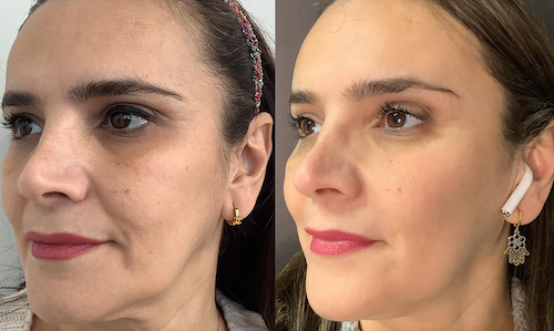 non surgical facial lift thread lift before after mississauga oakville